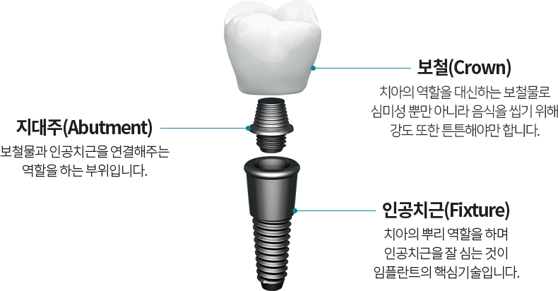 임플란트 구조